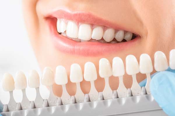 Can Dental Veneers Be Removed?